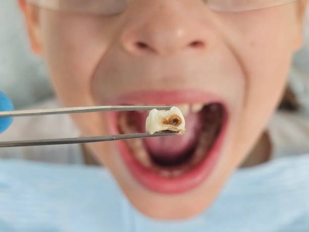 Best Emergency Dental Care for Broken or Chipped Teeth in Centerton, AR
